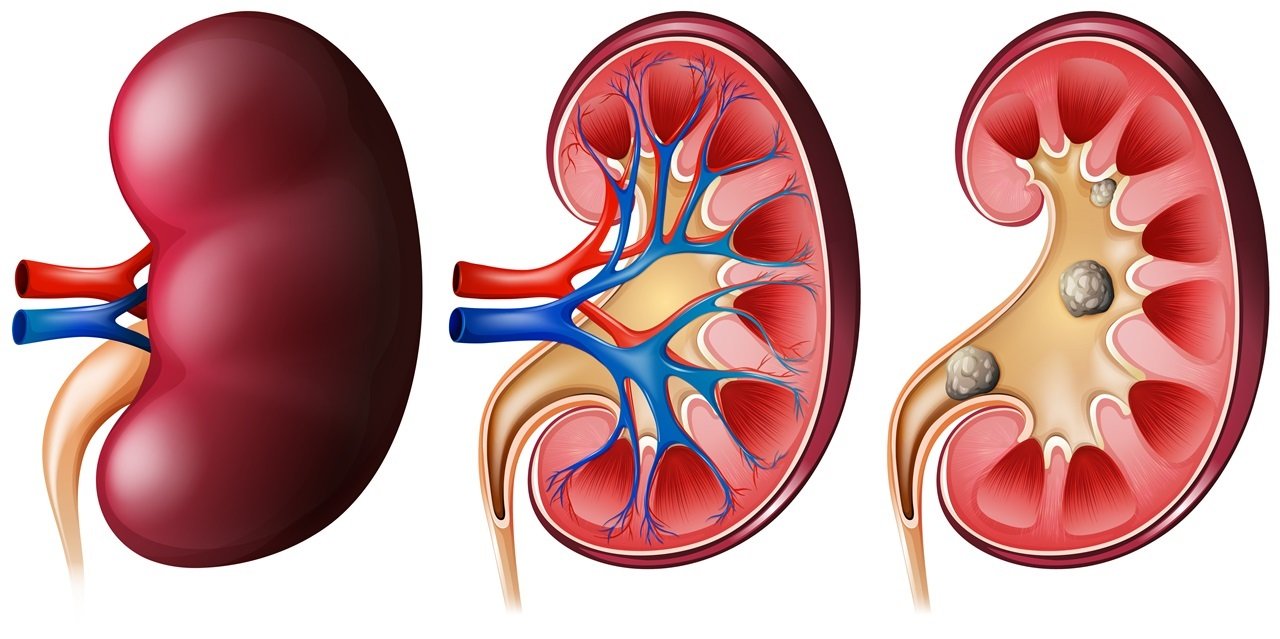 6 Types of Foods to Avoid with Kidney Problems